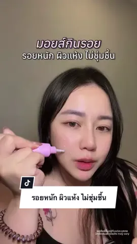 This video is for people who have severe red and black acne marks, or have rough,… TikTok video