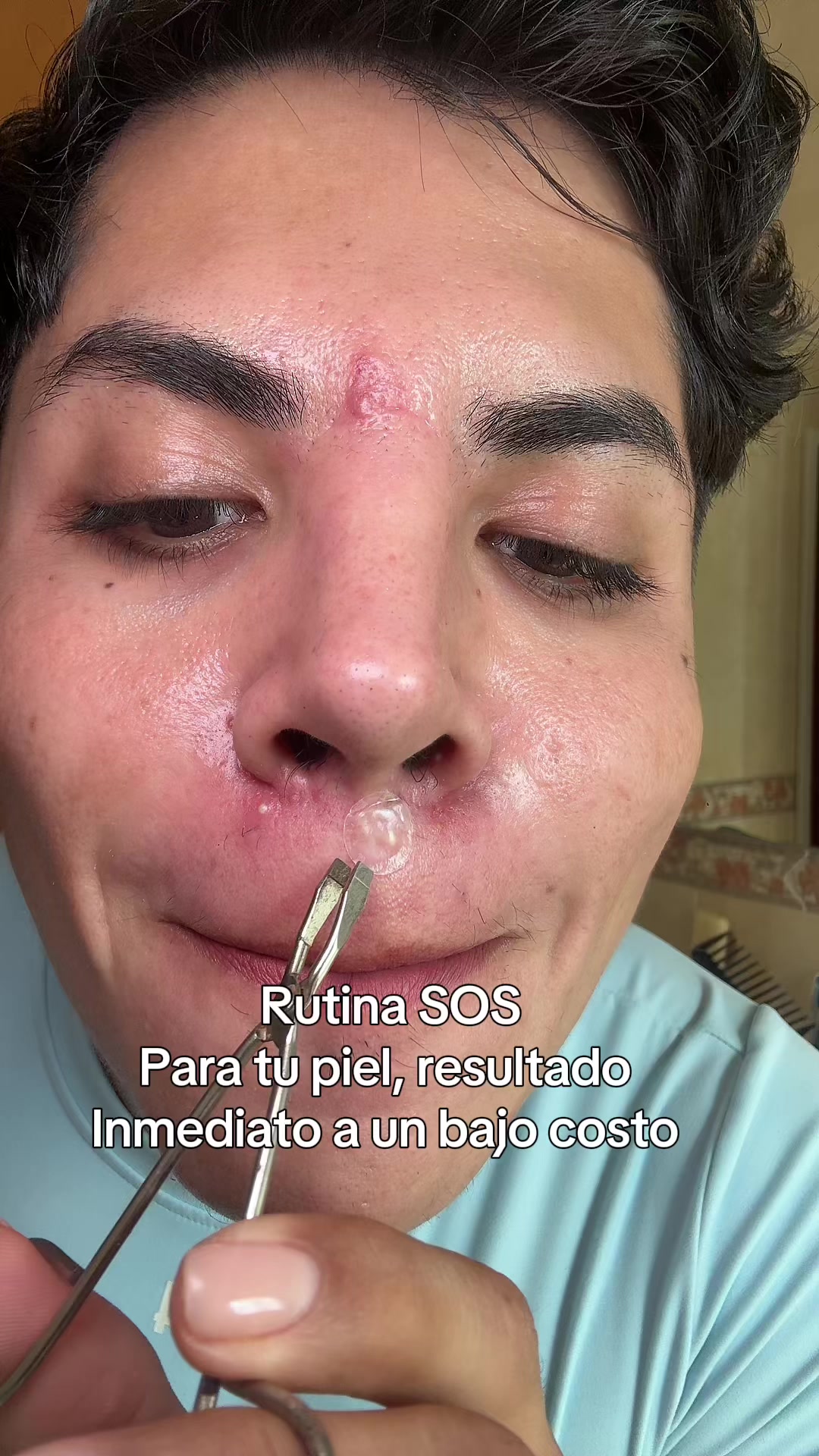 SOS Routine For your skin, Immediate result at low cost TikTok video