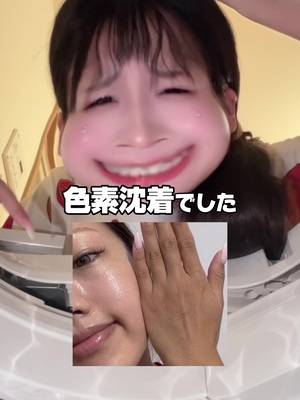 I thought I was naturally dark, but it was actually pigmentation. TikTok video
