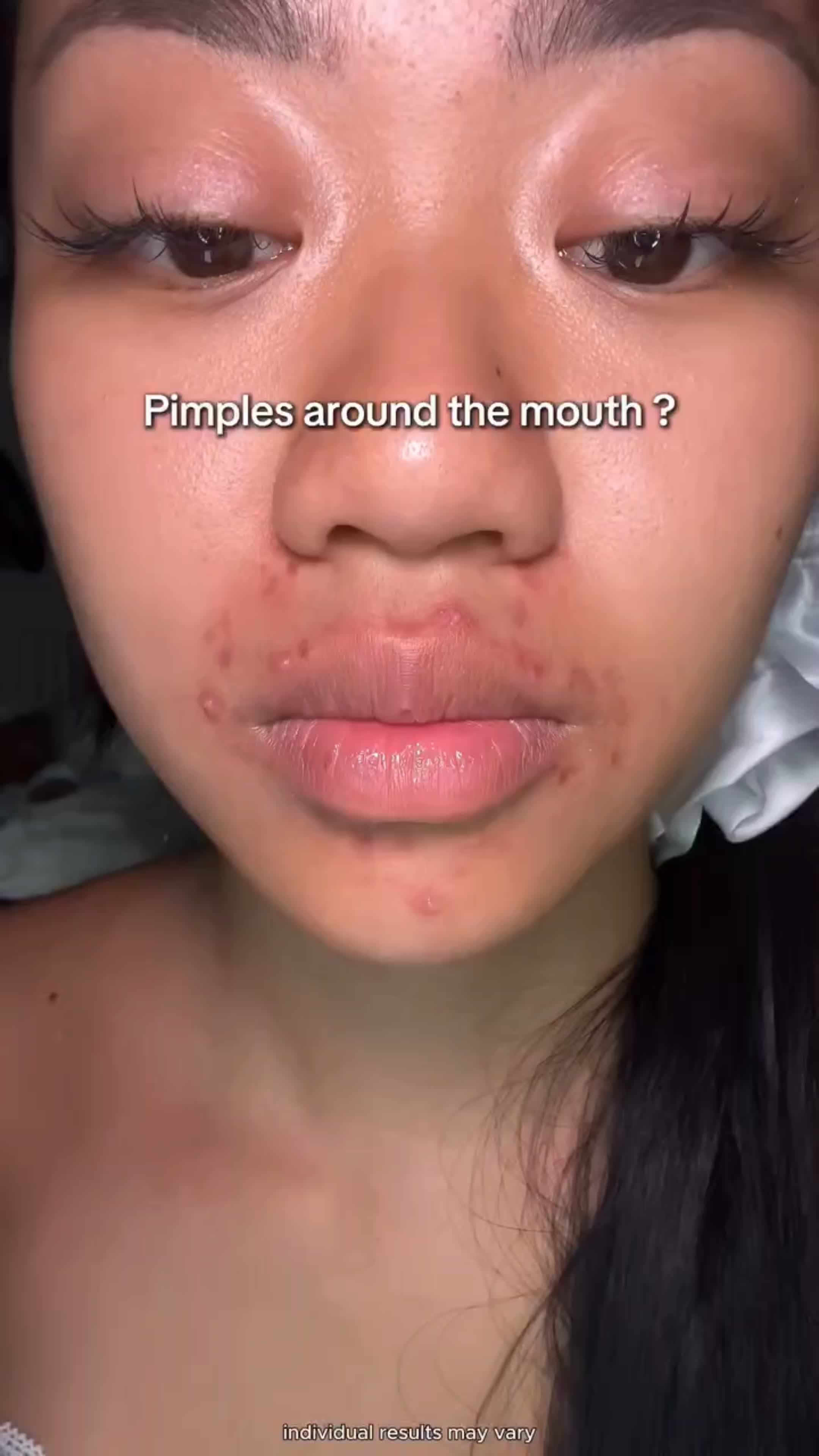 입 주변에 여드름이 났나요? TikTok video